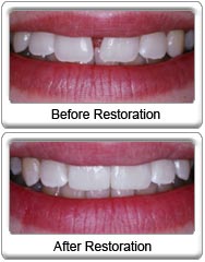 Before & After Dental Bonding