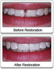 Before & After Dental Bonding